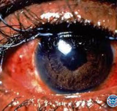 ICE highlights dangers of illegal decorative contact lenses