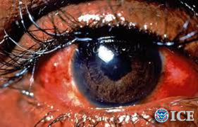 ICE highlights dangers of illegal decorative contact lenses